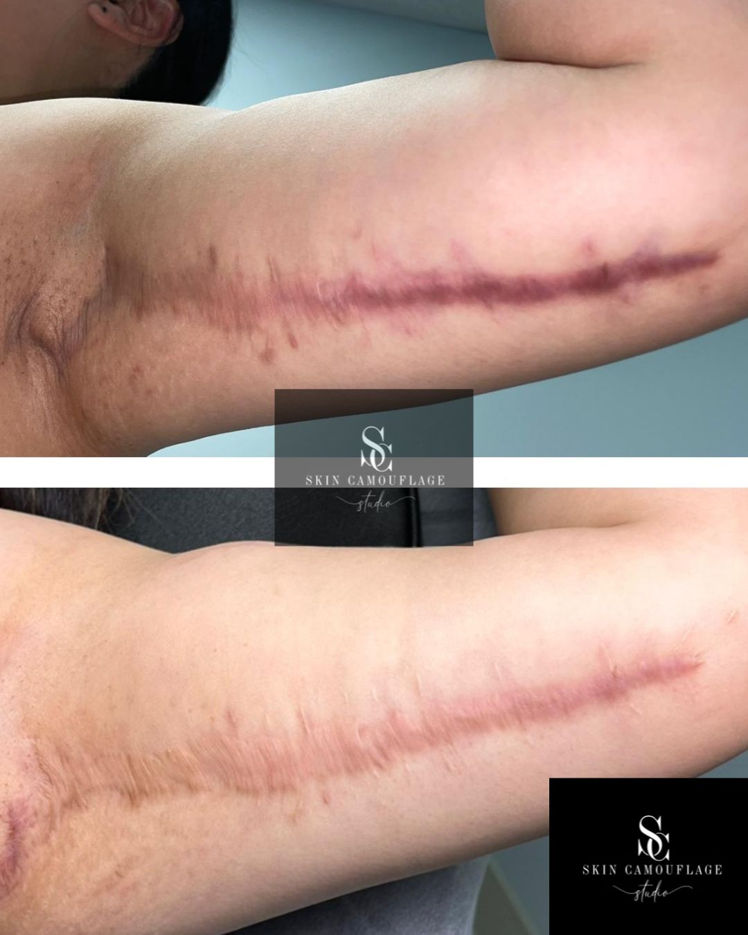 Inkless Needling Ergebnis – Narbe Oberarm nach 2 Behandlungen Narbe Oberarm vorher nachher Inkless Needling Behandlung Wiehl Köln