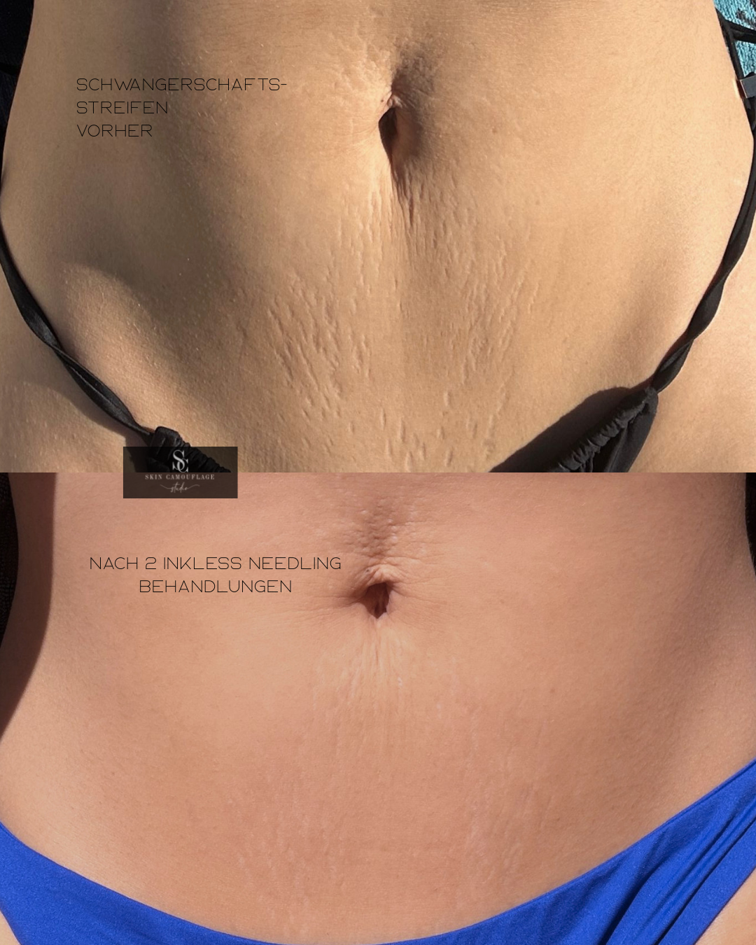 Schwangerschaftsstreifen Bauch vorher nachher Inkless Needling Behandlung Wiehl Köln