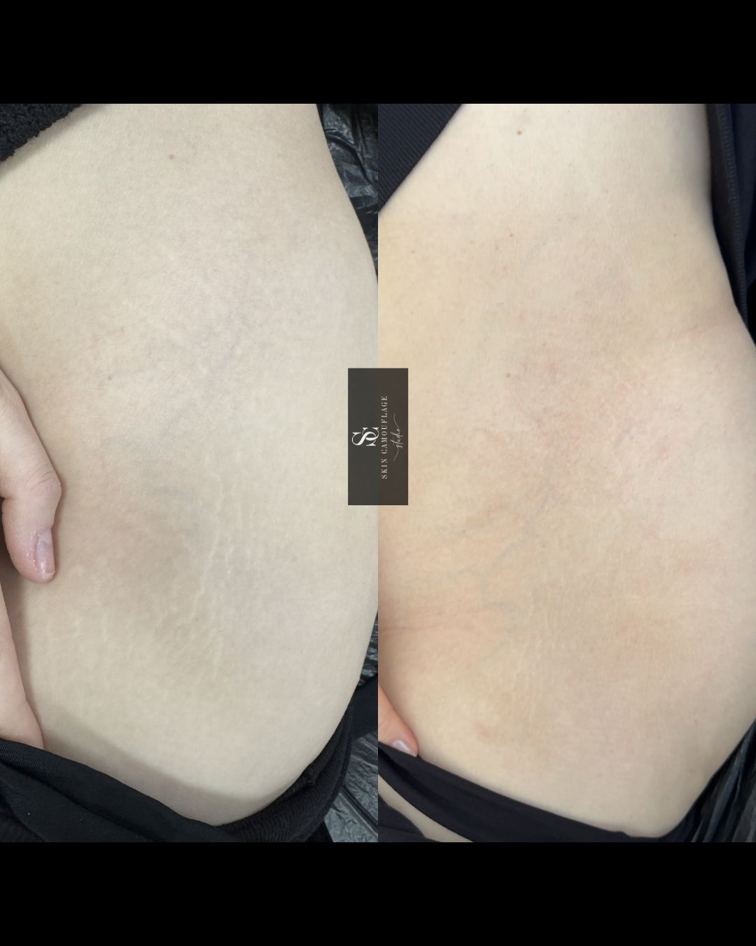 Inkless Needling Ergebnis – Dehnungsstreifen Taille Hüfte nach 1 Behandlung Dehnungsstreifen Taille Hüfte vorher nachher Inkless Needling Ergebnis Wiehl Köln